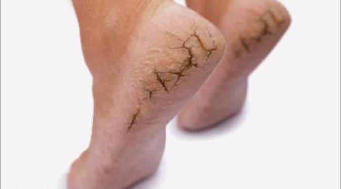 dry-skin-on-feet